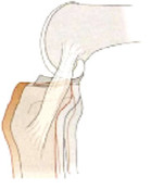 diagnostischer Test zur Bestimmung des verletzten Kreuzbandes