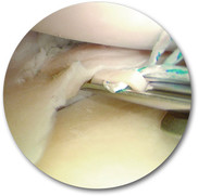 Opertation des Meniskus