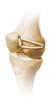 Mediales patellofemorales Ligament (MPFL)