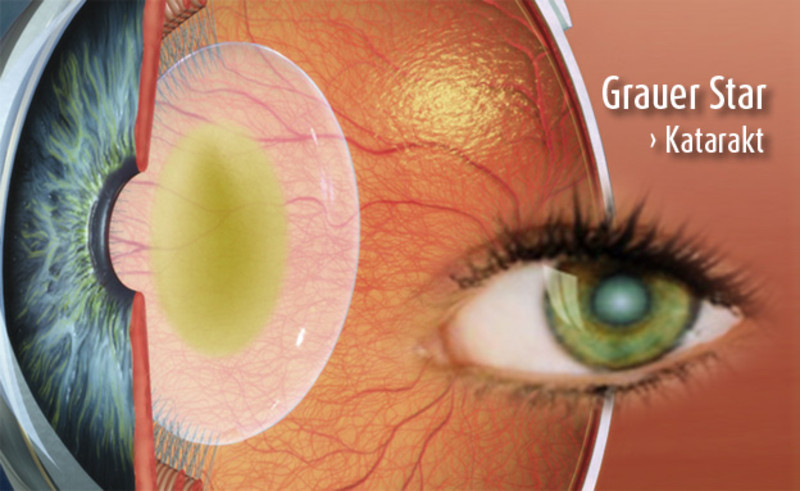 Schema Grauer Star (med. Katarakt)