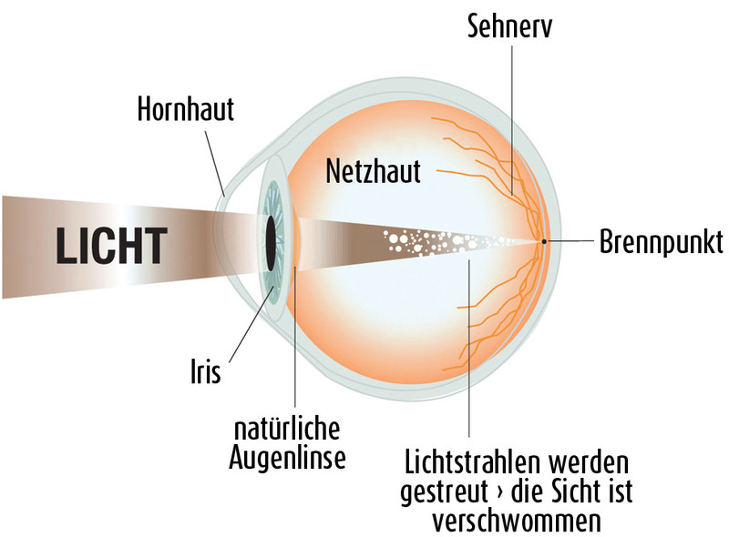 beschriftetes Schema über Lichteinfall ins Auge