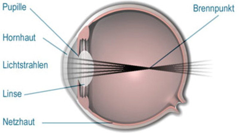 beschriftetes Schema über den Lichteinfall ins Auge bei Kurzsichtigkeit