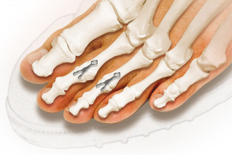 Knochen im Fuß mit Smart Toe Implantat